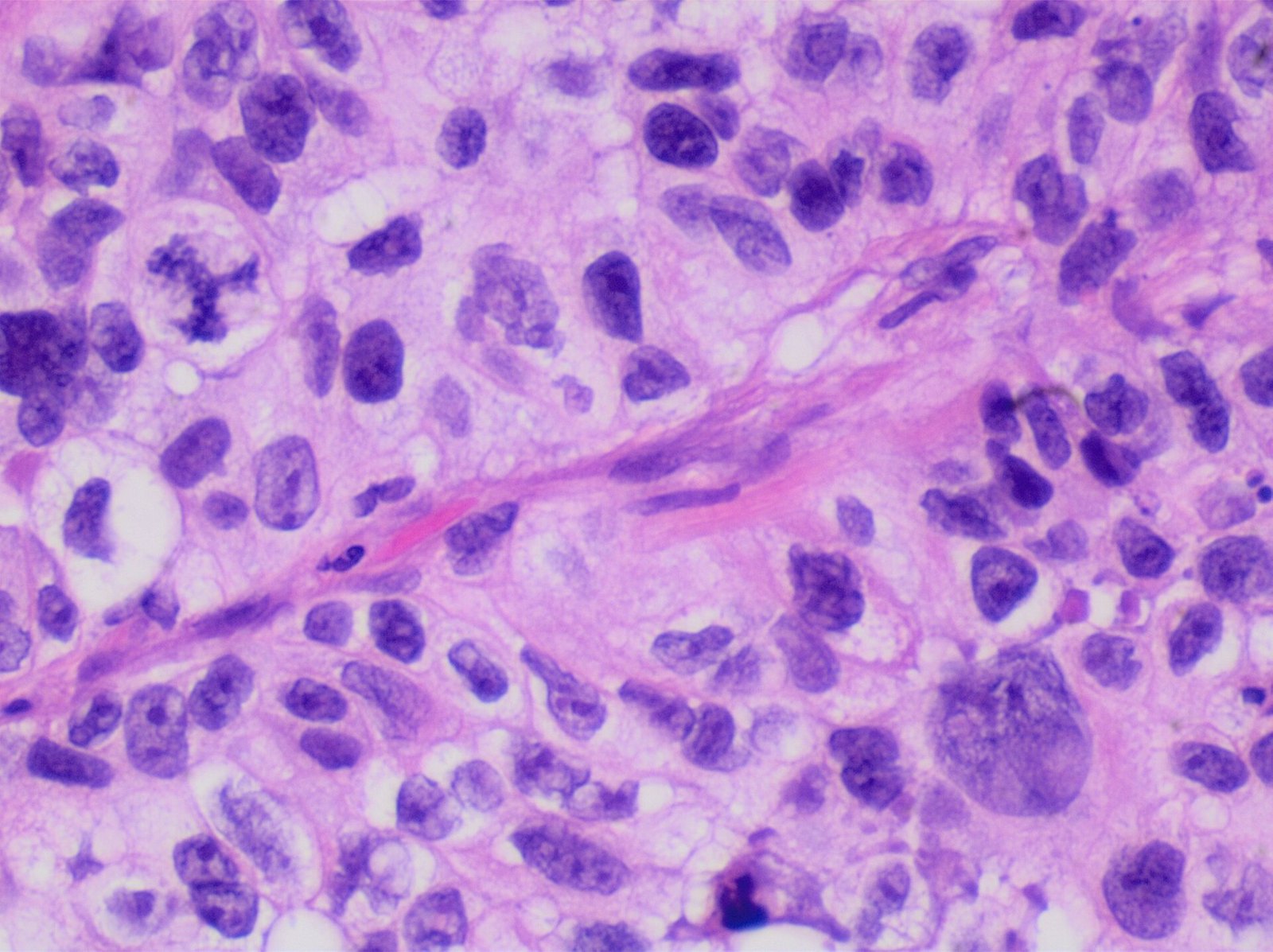 Histopathology of poorly differentiated lung adenocarcinoma