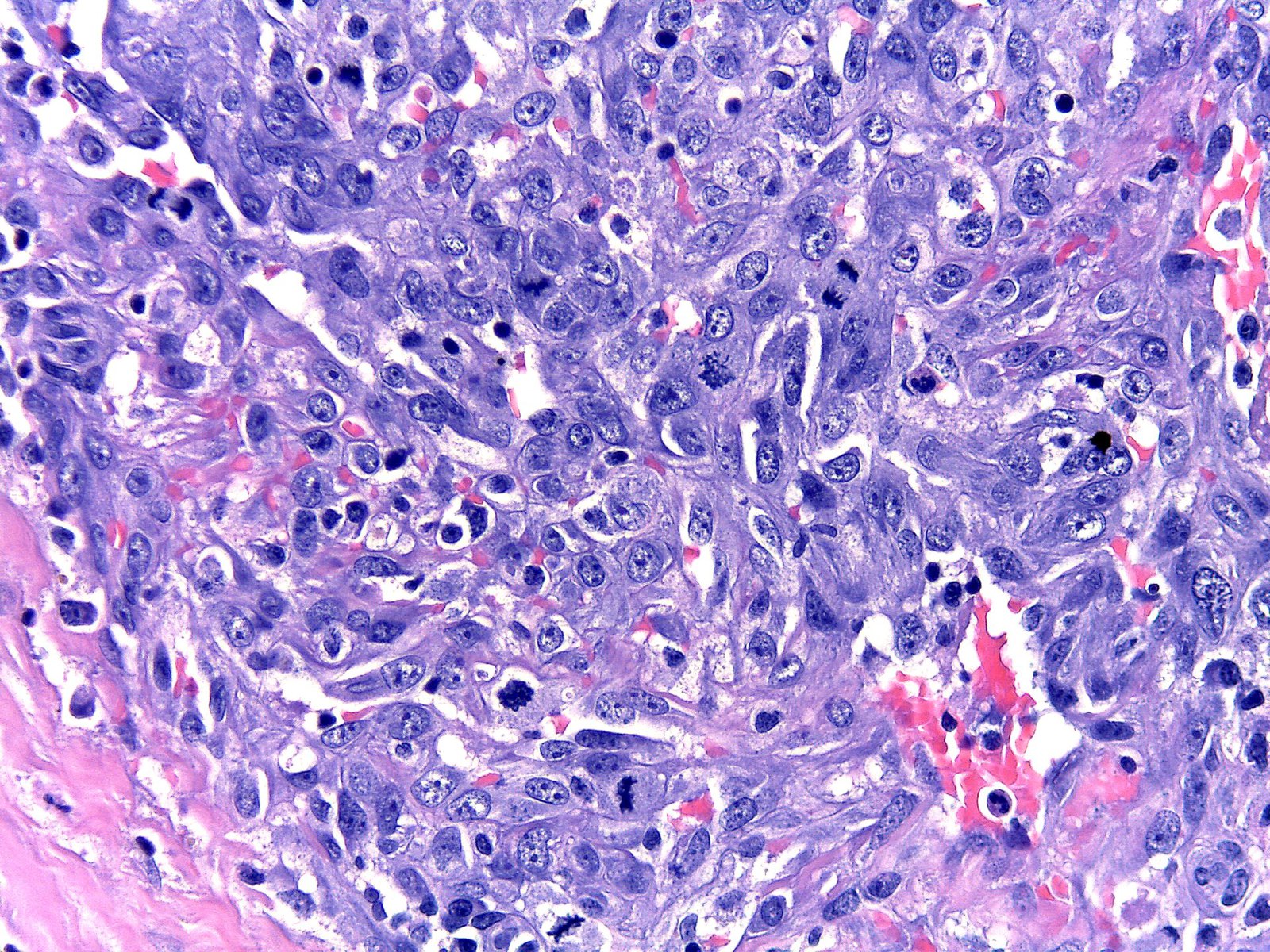 Kaposi sarcoma in a patient with HHV8-associated MCD
