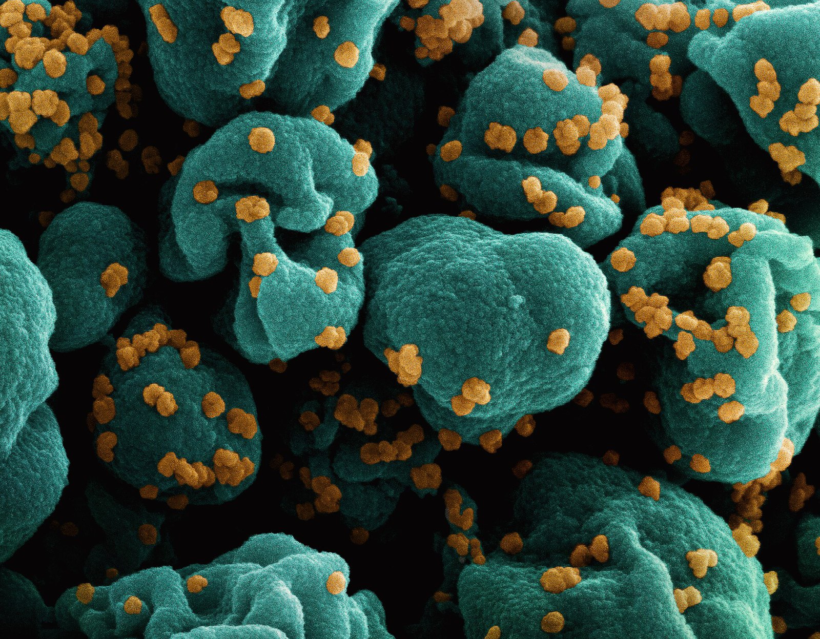 Colorized scanning electron micrograph of a cell (teal) infected with SARS-CoV-2 virus particles (orange), isolated from a patient sample