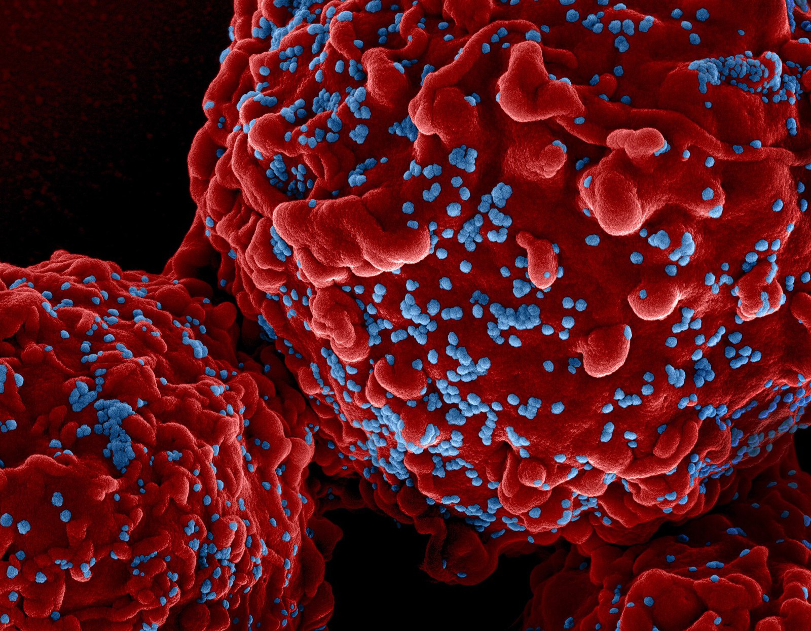 HIV-1 virus particles colorized scanning electron micrograph - 111