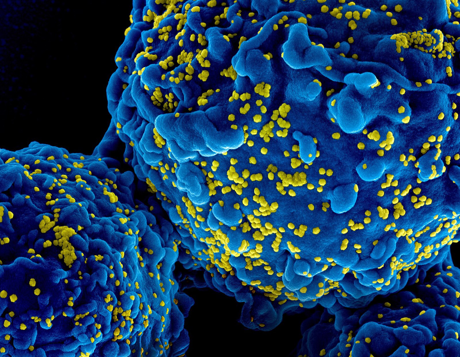 HIV-1 virus particles colorized scanning electron micrograph - 211