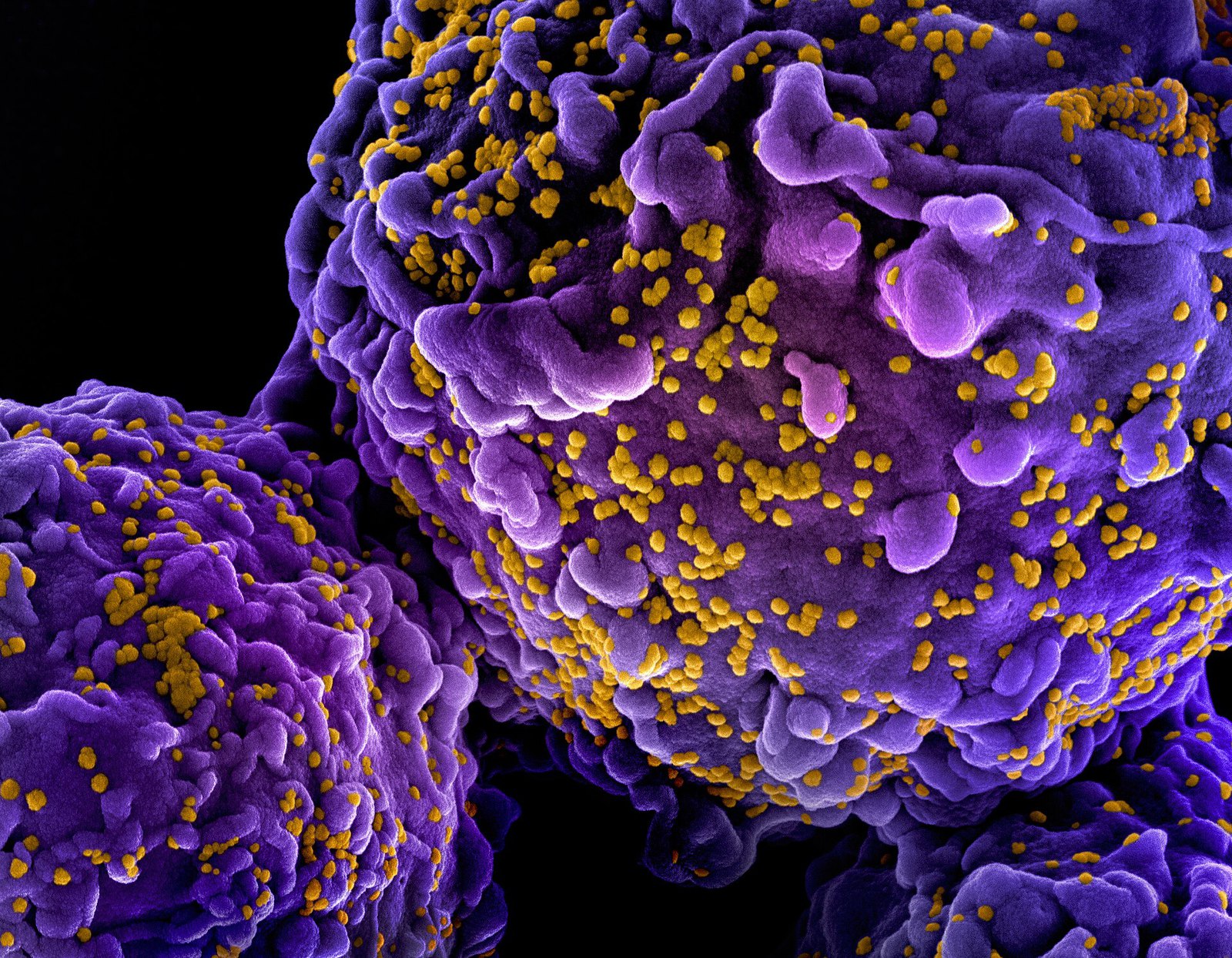 HIV-1 virus particles colorized scanning electron micrograph - 311