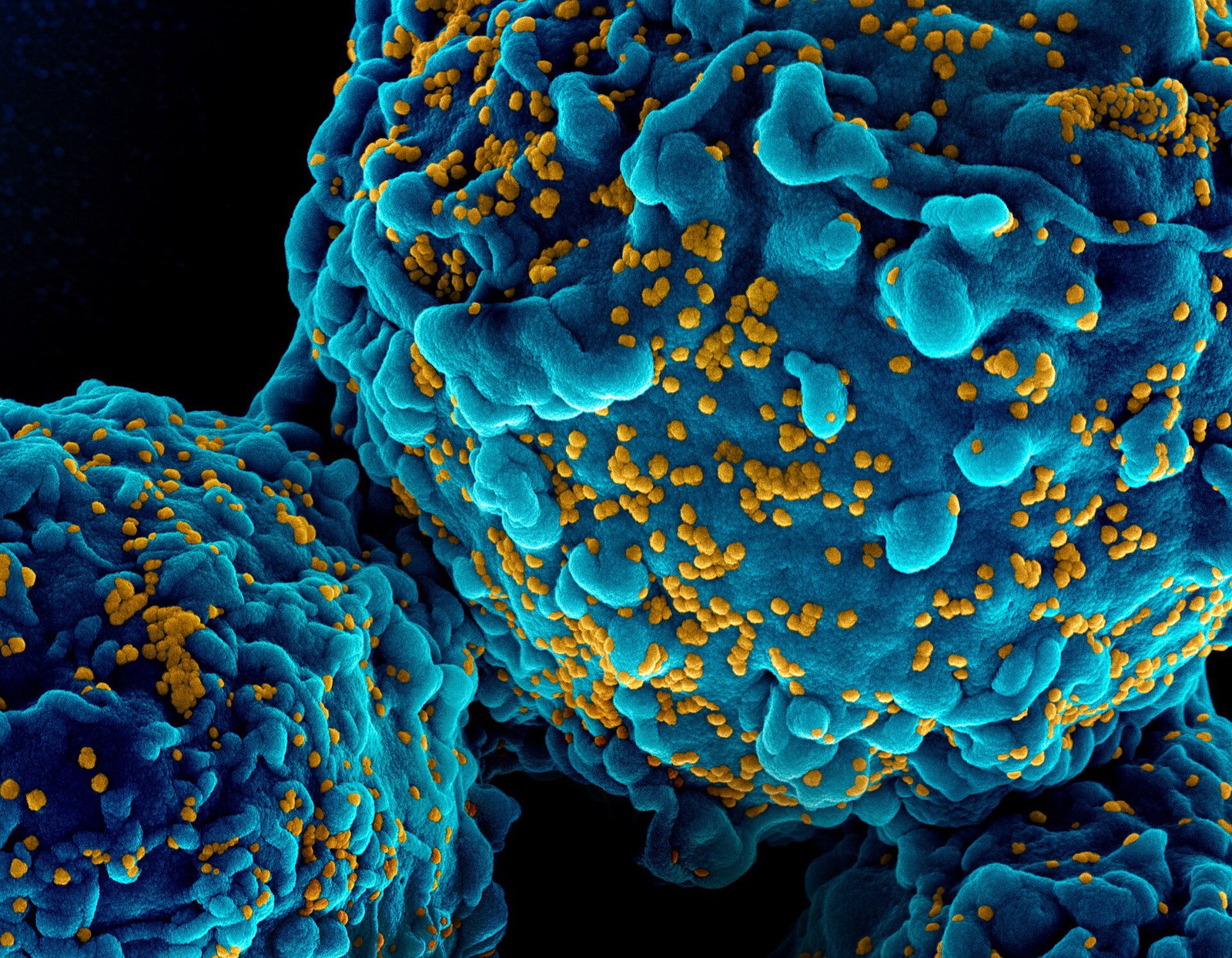 HIV-1 virus particles colorized scanning electron micrograph - 411
