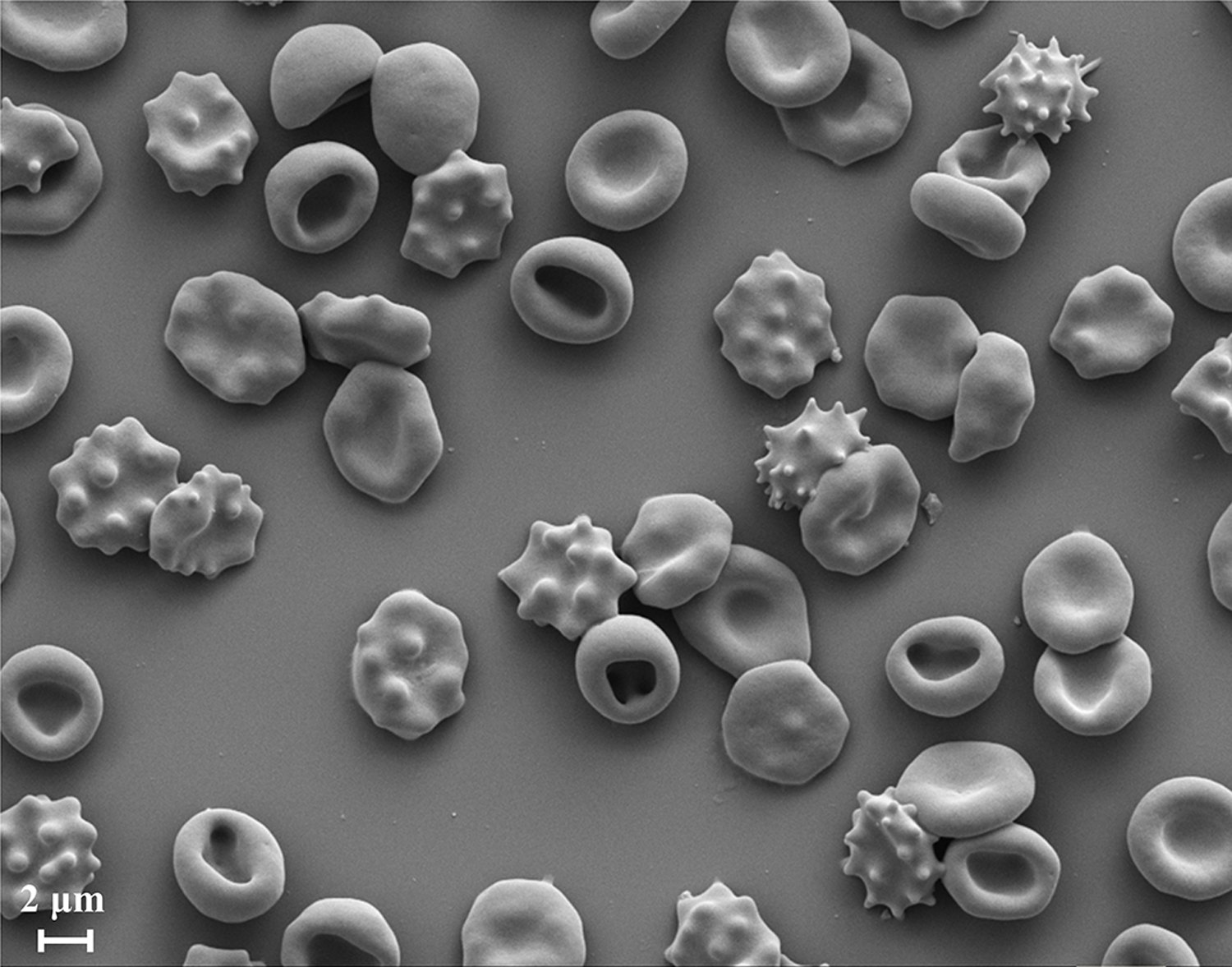 Scanning electron microscope (SEM) image of a RBC population having different morphology stages of stomatocytosis and echinocytosis