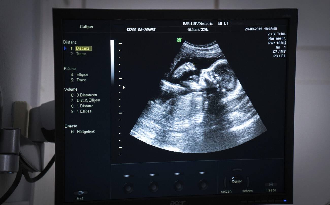 Obstetric ultrasound scan monitor showing 20-week human fetus profile in Navi Mumbai 2015