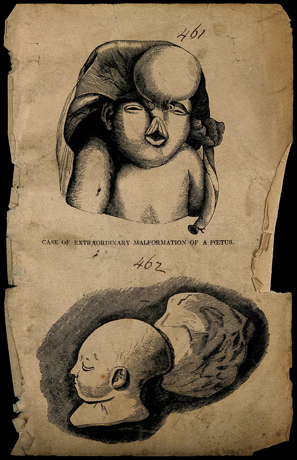 A malformed foetus. Wood engraving. Wellcome V0007401