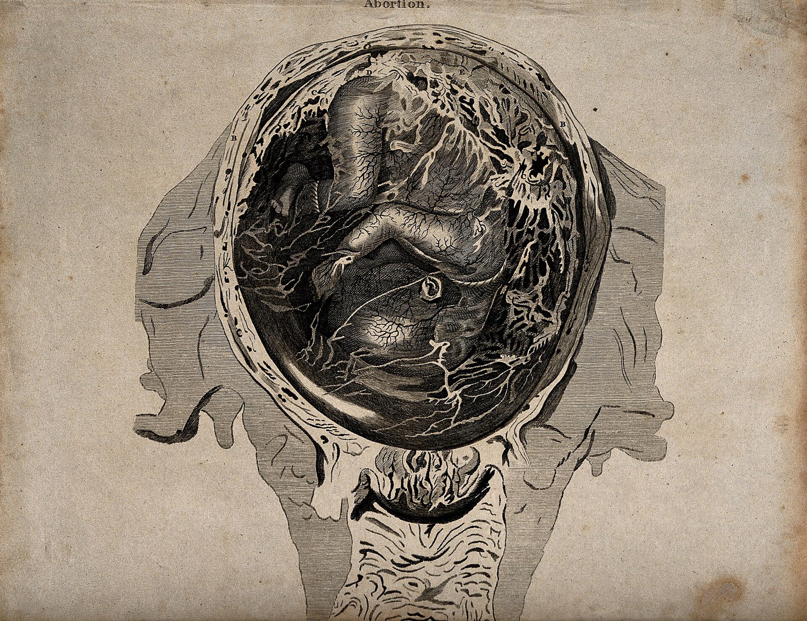 An abnormal foetus in the womb, which is about to be natural Wellcome V0014954