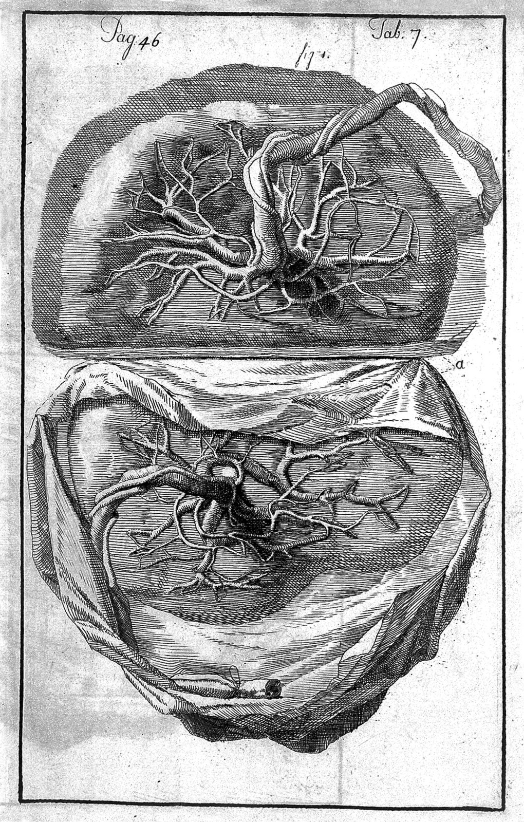 Placenta belonging to twins. Wellcome L0009816