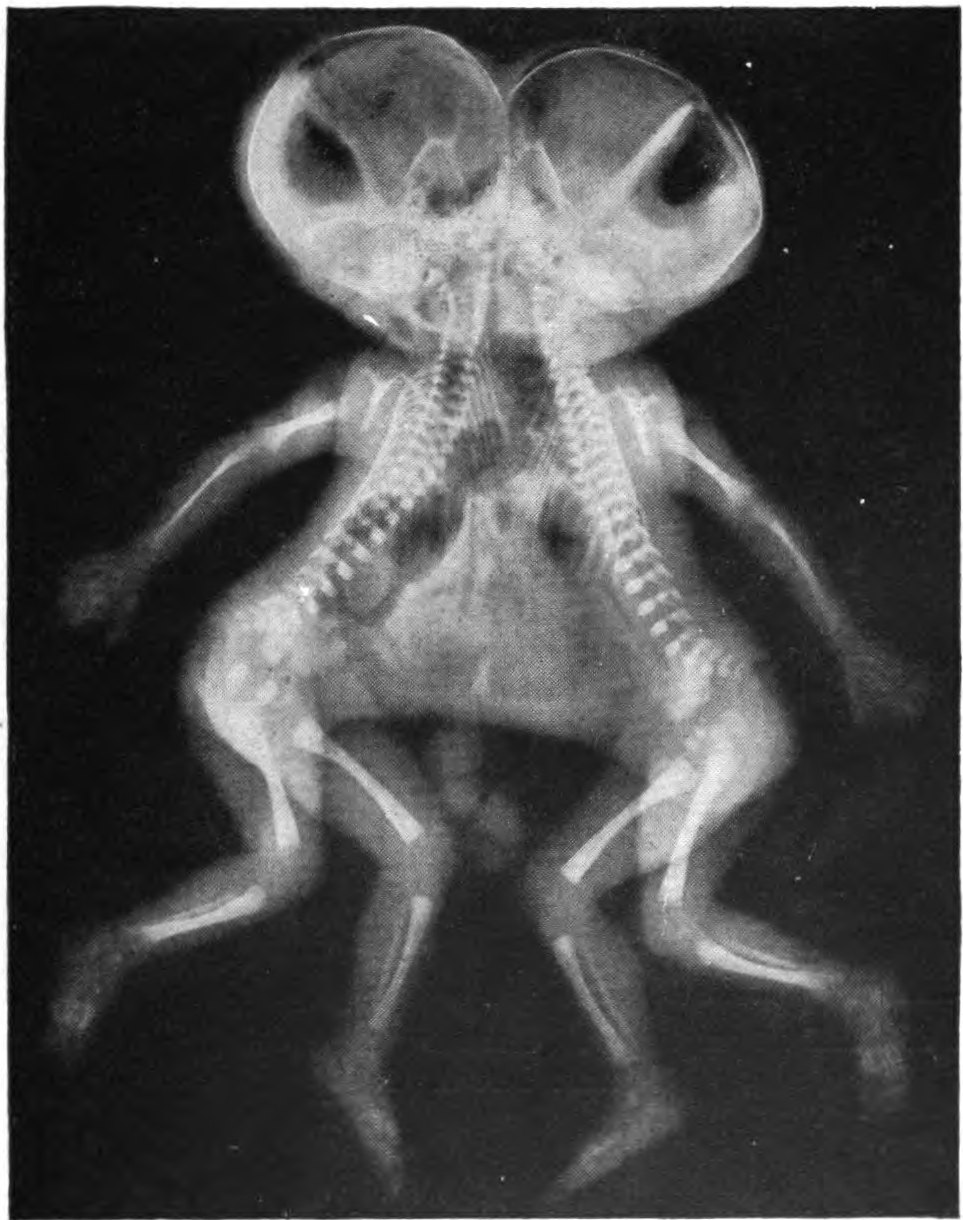 Conjoined X-ray